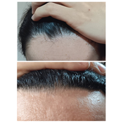 Fenotipos, línea frontal del pelo